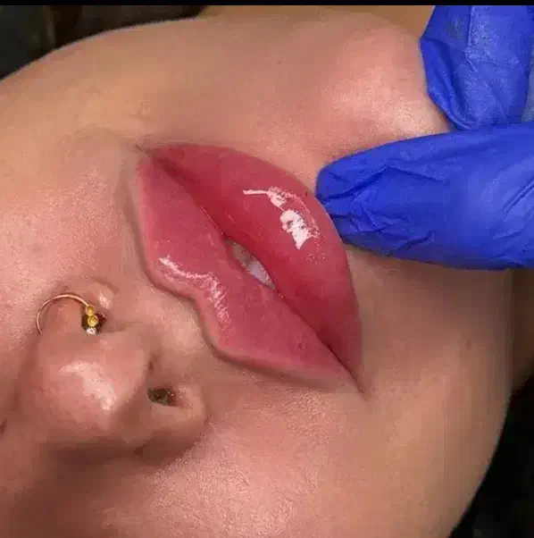 بوتاکس ژل لب گونه چانه فک پر کردن صورت لاغر نخ مزو|خدمات آرایشگری و زیبایی|قم, زنبیل آباد|دیوار