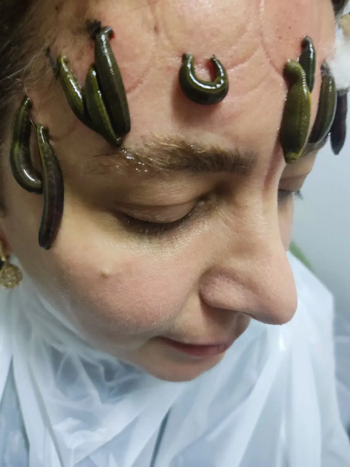 تخفیف۵۰٪ حجامت، فصد پیشانی، زالو، غلظت واریس دیسک|خدمات آرایشگری و زیبایی|اصفهان, برازنده|دیوار