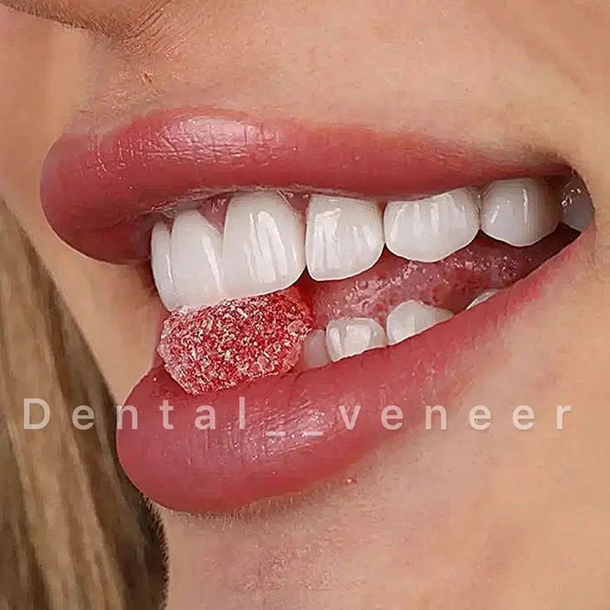 دندانپزشکی لمینت الهیه منطقه ۱ کامپوزیت سرامیکی|خدمات آرایشگری و زیبایی|تهران, الهیه|دیوار