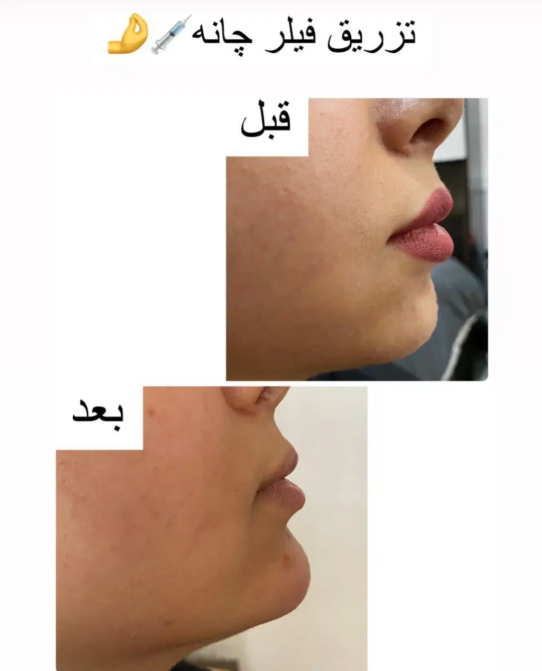 خدمات ژل بوتاکس آنزیم فیلر جوانساز مرو سر ابرو|خدمات آرایشگری و زیبایی|چهارباغ, |دیوار