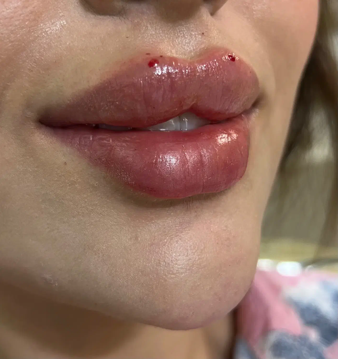 تزریق فیلر و بوتاکس|خدمات آرایشگری و زیبایی|قرچک, مهدیه|دیوار