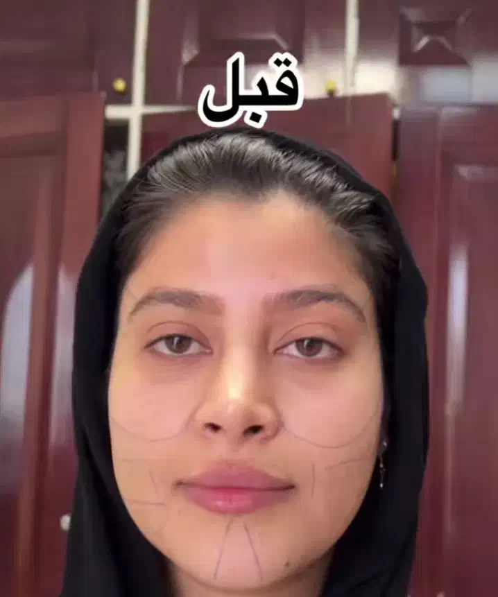 تزریق چربی ، تزریق ژل ، بوتاکس ، جراحی در مطب|خدمات آرایشگری و زیبایی|نورآباد, |دیوار