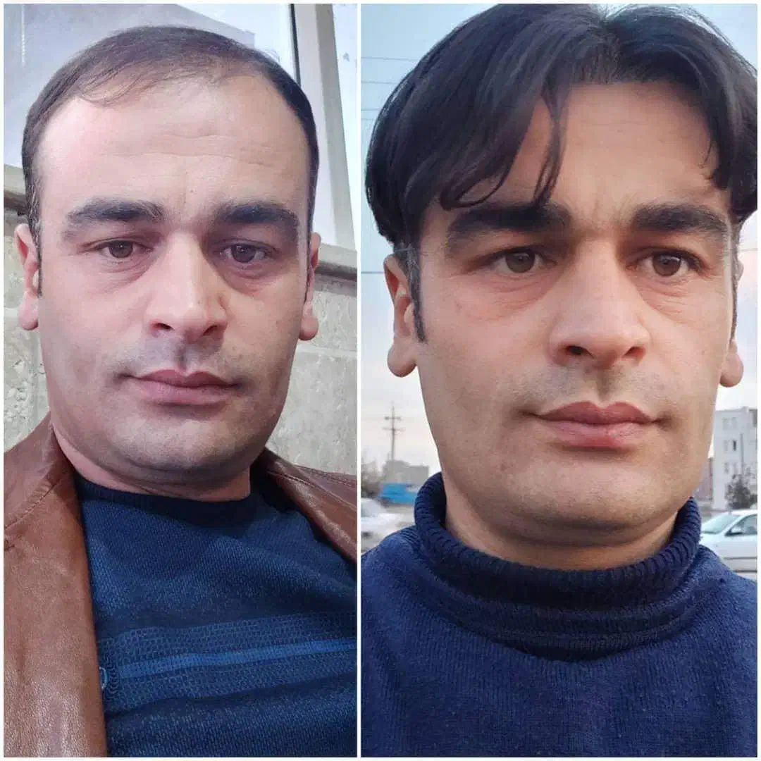 کاشتموپرتراکم برای اهل مراغه با اقساط وهتل رایگان|خدمات آرایشگری و زیبایی|مراغه, |دیوار