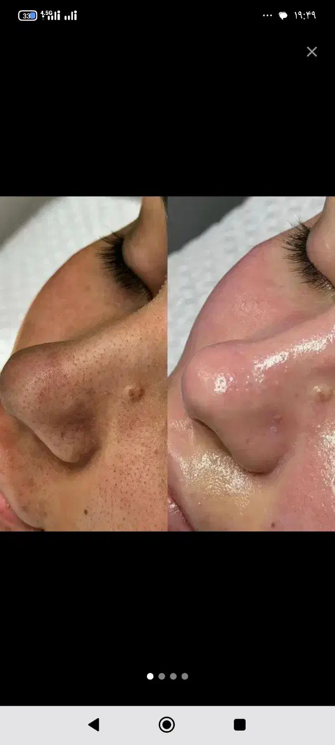 تخفیفات جشنواره فشیال و پاکسازی تخصصی پوست|خدمات آرایشگری و زیبایی|اصفهان, الهیه|دیوار