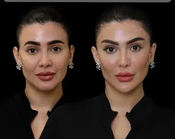 جوان کردن صورت در یک جلسه هایفو تراپی با ۸۵۰هزار ت|خدمات آرایشگری و زیبایی|اصفهان, احمدآباد|دیوار