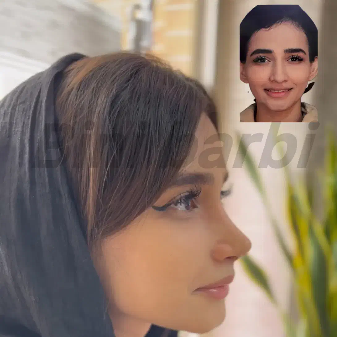 عمل بینی -۱۸م-فوق تخصص جراحی پلاستیک|خدمات آرایشگری و زیبایی|تهران, قیطریه|دیوار