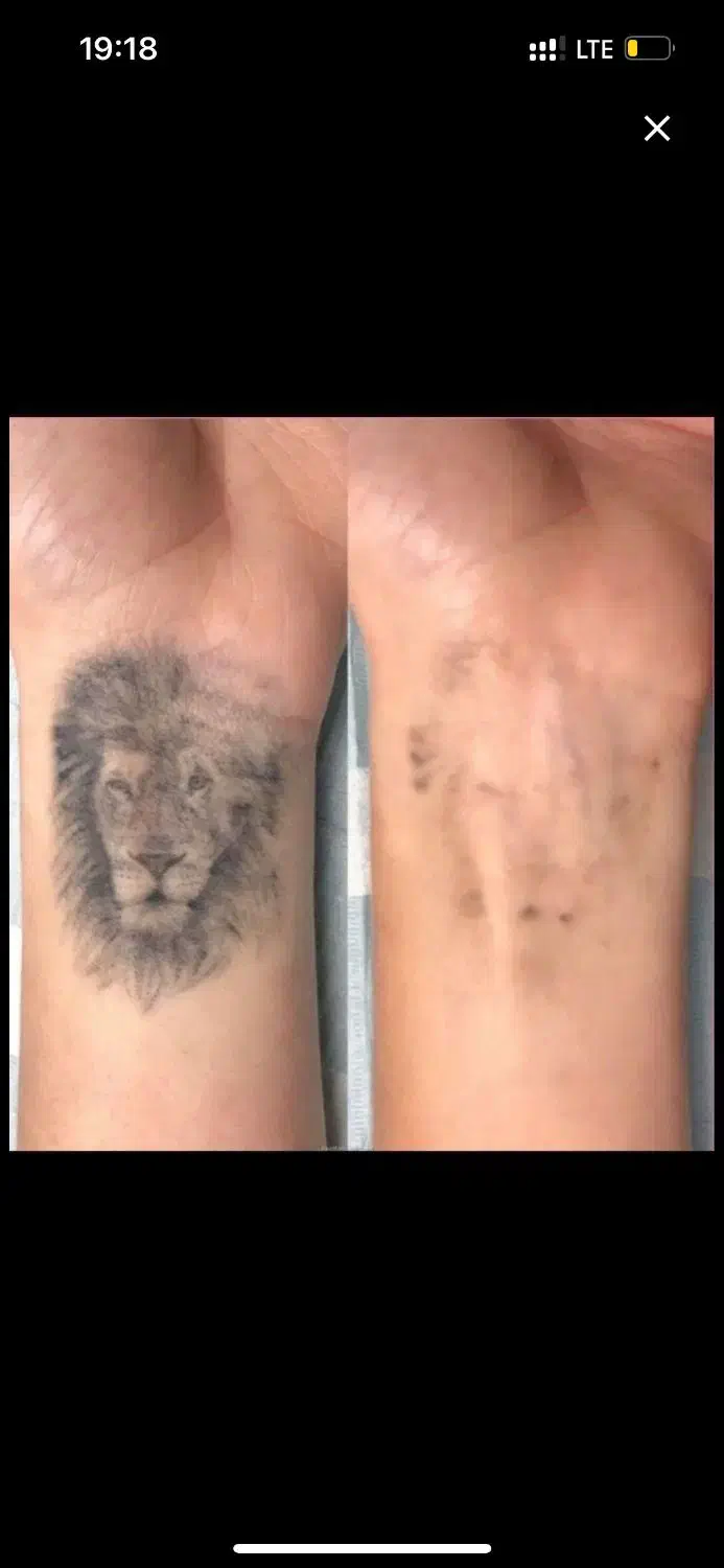 ریموتتو ابرو و بدن با پیشرفته ترین دستگاه تضمینی|خدمات آرایشگری و زیبایی|اهواز, کیانپارس |دیوار