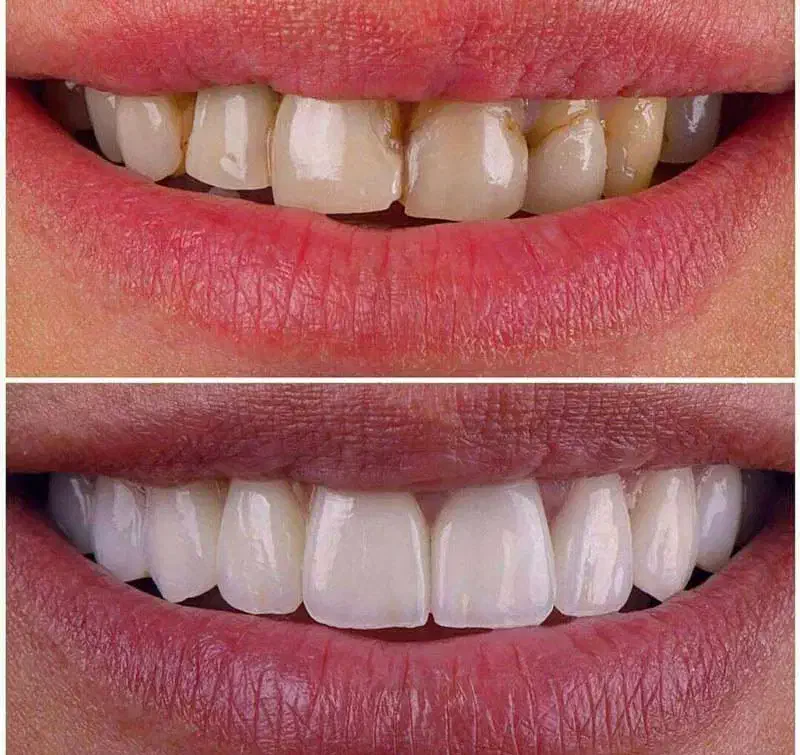 مهمترین عنصر زیبایی صورت ظاهر دندانهاست|خدمات آرایشگری و زیبایی|عنبرآباد, |دیوار