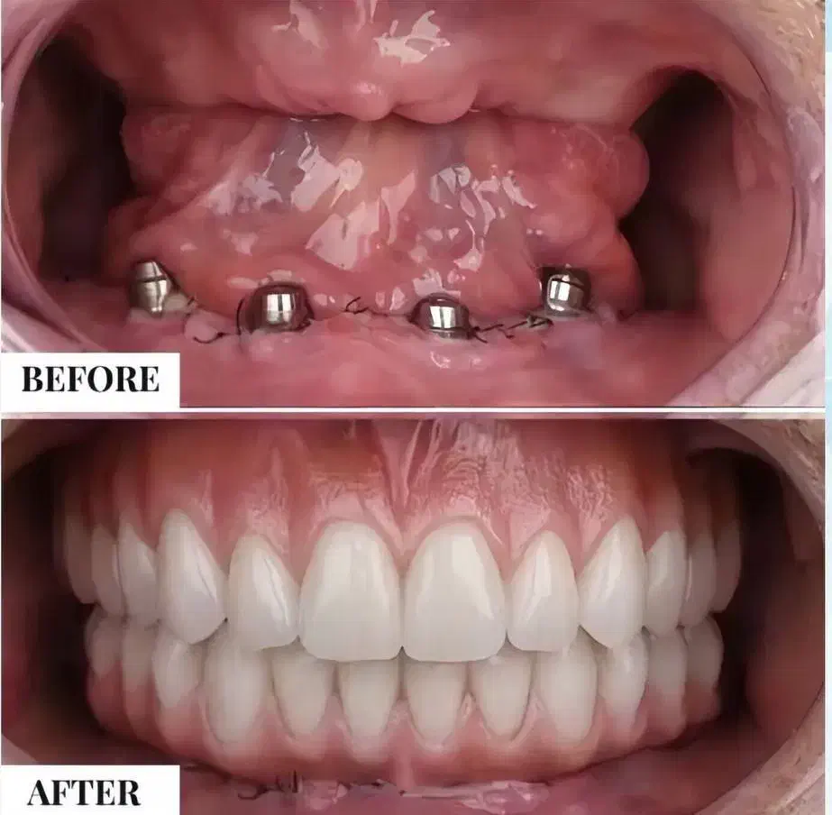 جشنواره دندانپزشکی ، ایمپلنت فقط ۱۰/۳۰۰|خدمات آرایشگری و زیبایی|تبریز, |دیوار