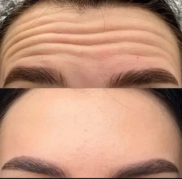 تزریق ژل و بوتاکس|خدمات آرایشگری و زیبایی|دوگنبدان, |دیوار