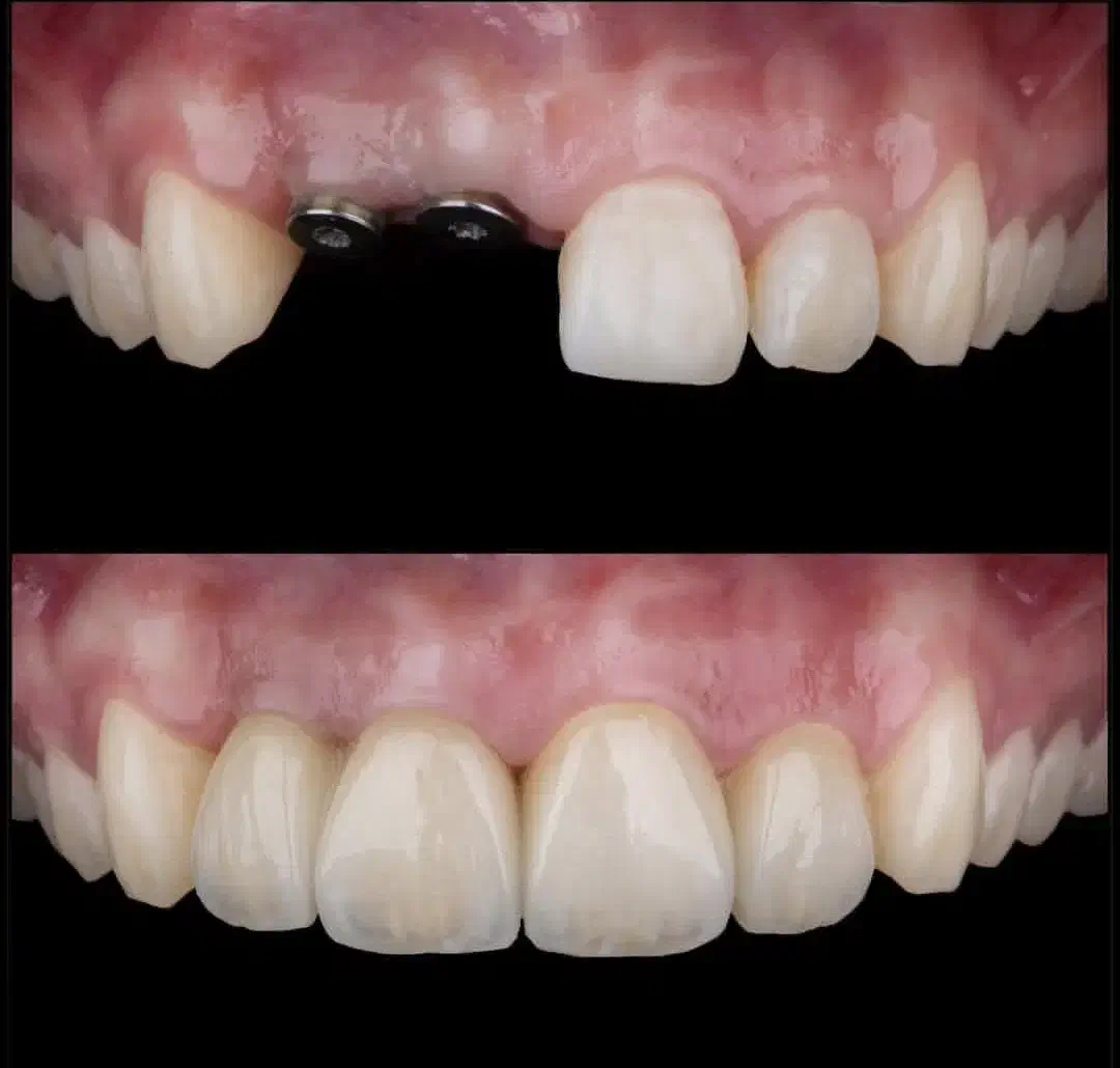 دندانپزشکی ایمپلنت تخصصی از ۵ میلیون اقساطی وام|خدمات آرایشگری و زیبایی|تبریز, |دیوار