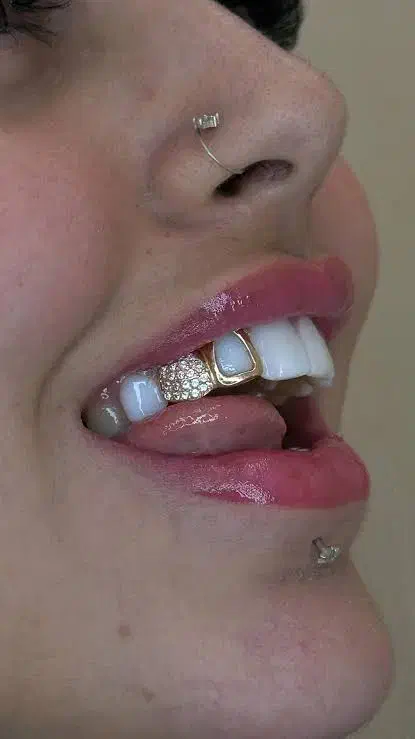 روکش دندان سرامیکی به مدت محدود|پزشکی|تهران, فردوس|دیوار