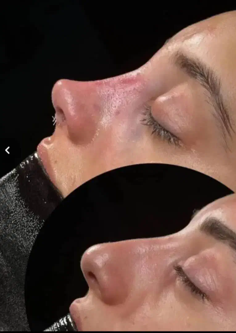 جراحی و عمل بینی توسط متخصص|خدمات آرایشگری و زیبایی|چهارباغ, |دیوار