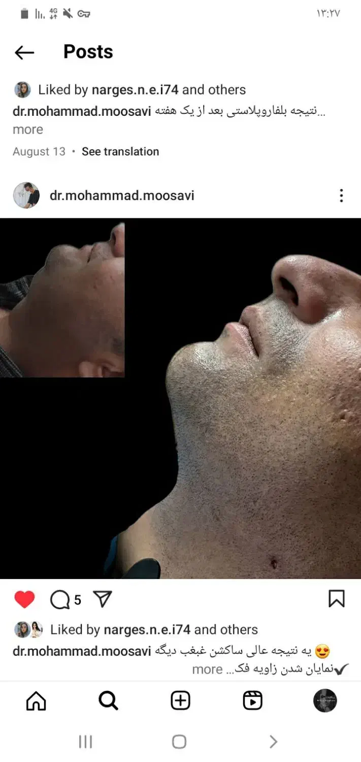 ژل .بوتاکس .هایفو.ساکشن غبغب وساکشن شکم وپهلو|خدمات آرایشگری و زیبایی|اصفهان, رکن الدوله غربی|دیوار