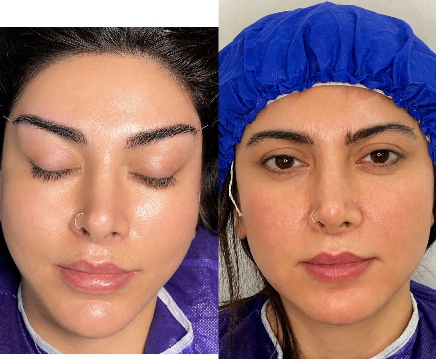 جراحی لیفت شقیقه دایرکت ابرو و تحتانی بخیه لیزری|خدمات زیبایی و سلامت|تهران, ایوانک|دیوار