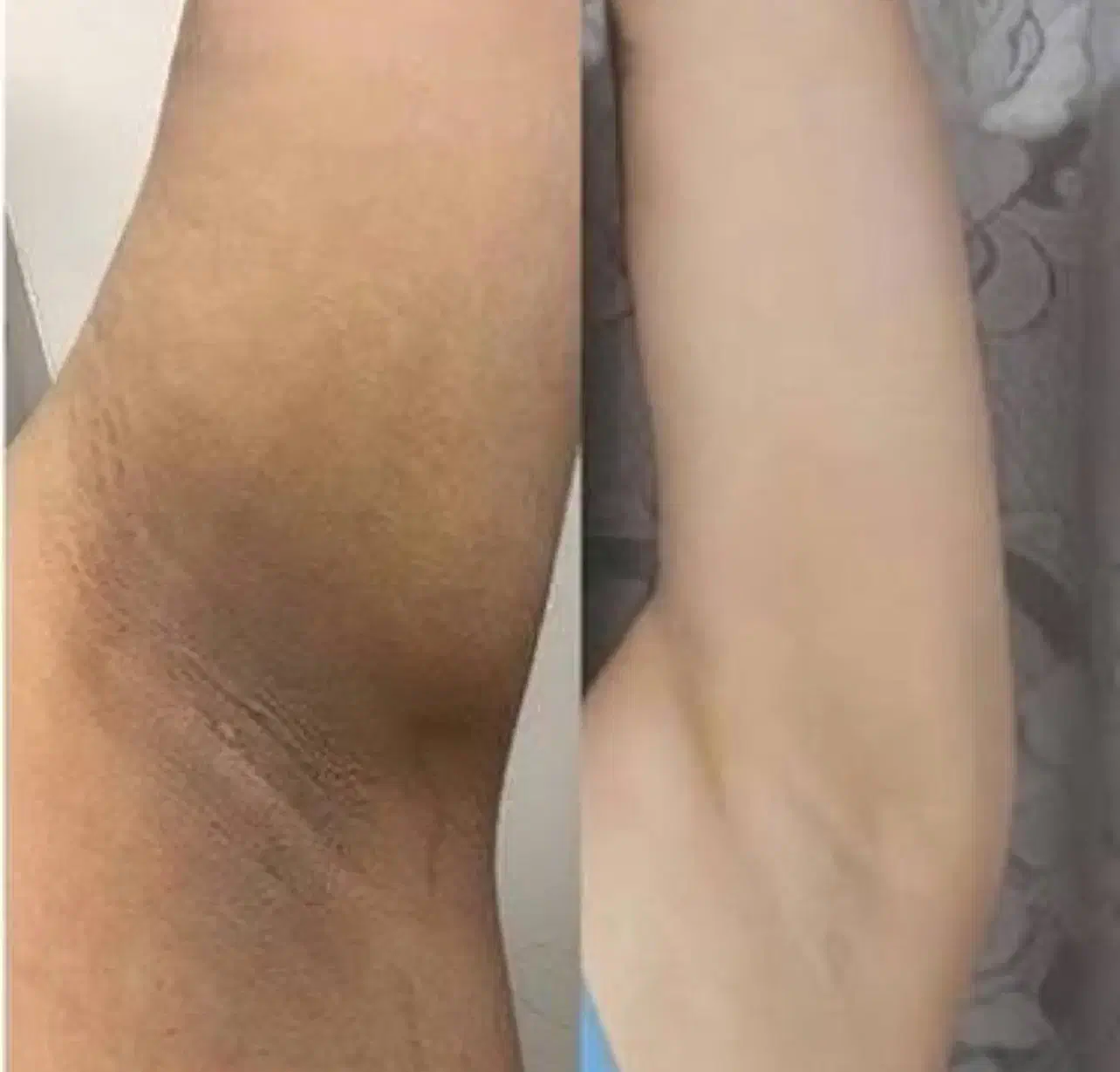 سفیدکردن‌نواحی تیره بدن|خدمات آرایشگری و زیبایی|ارومیه, |دیوار