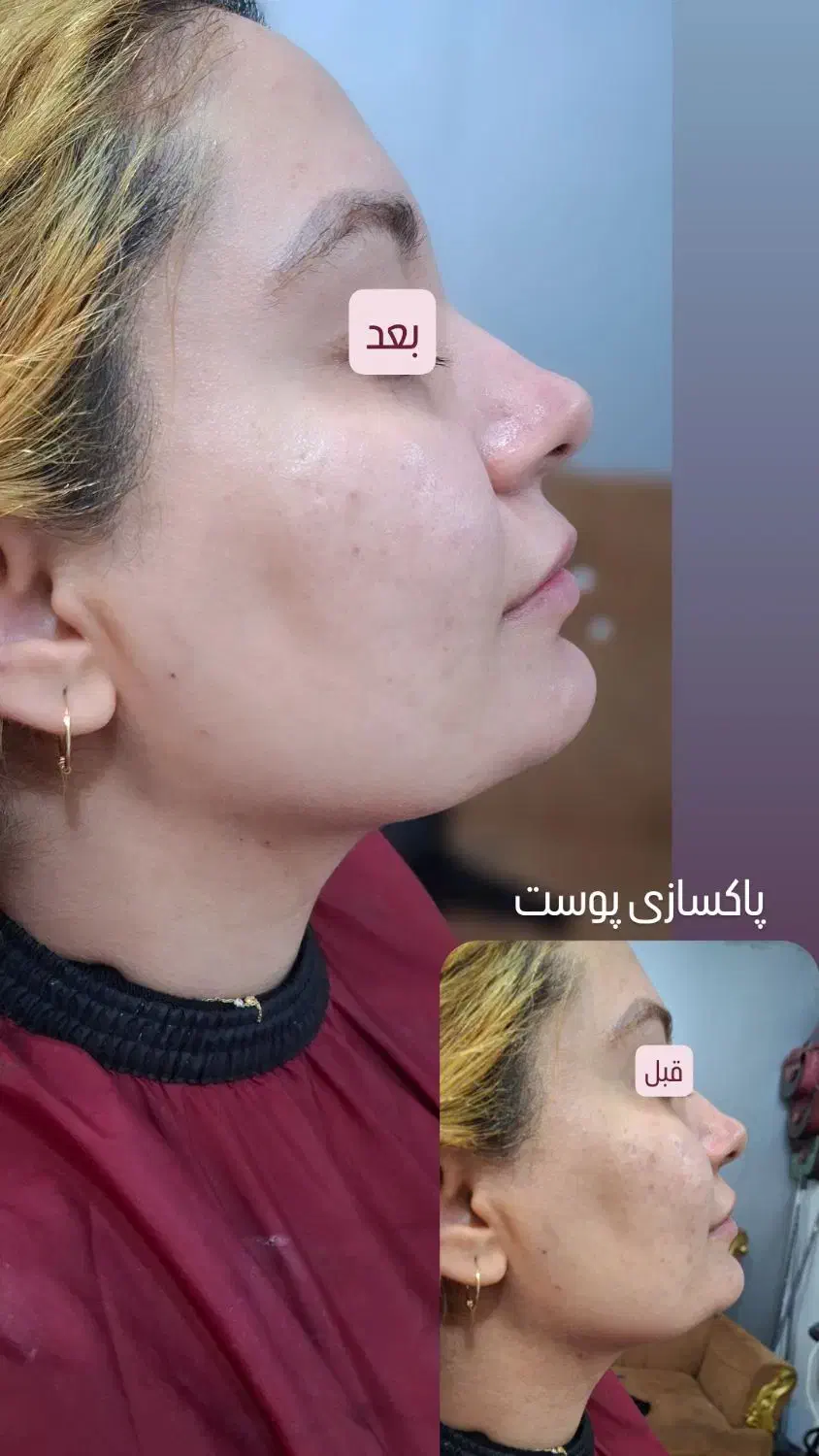 تا آخرهفته، مدل پاکسازی فقط با 198تومن|خدمات آرایشگری و زیبایی|رشت, جهاد|دیوار