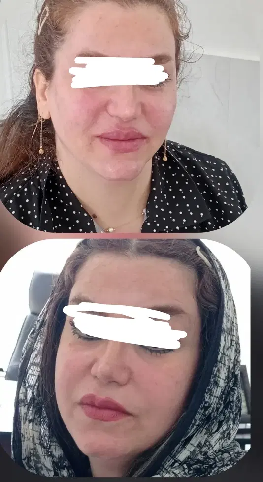 فیلر|خدمات زیبایی و سلامت|اسلام‌‌آباد غرب, |دیوار