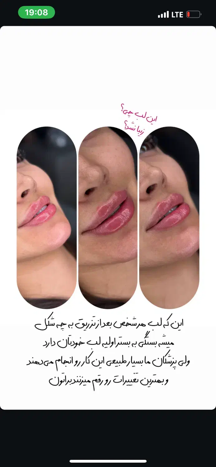 تزریق فیلر لب و صورت با ۵۰درصد تخفیف|خدمات آرایشگری و زیبایی|تهران, زعفرانیه|دیوار