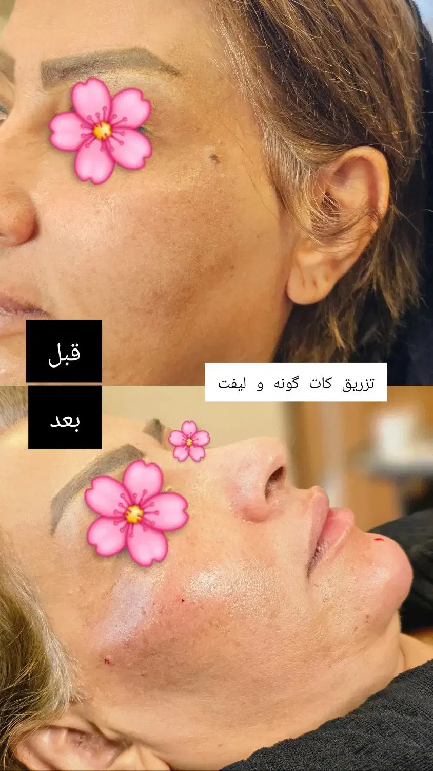 چهره‌ای که عاشقش میشی،بوتاکس،ژل وفیلر توسط متخصص|خدمات آرایشگری و زیبایی|ارومیه, |دیوار