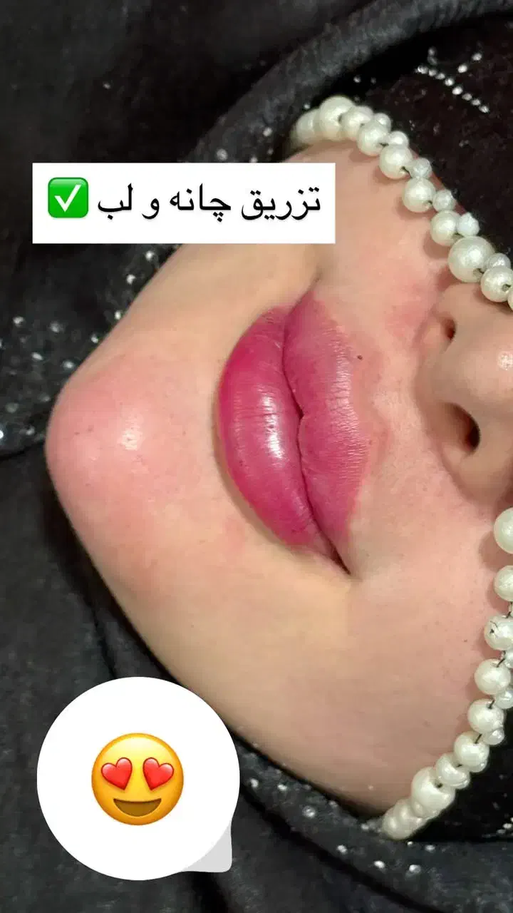 ژل،بوتاکس،مزوتراپی،مزونیدلینگ|خدمات آرایشگری و زیبایی|دوگنبدان, |دیوار