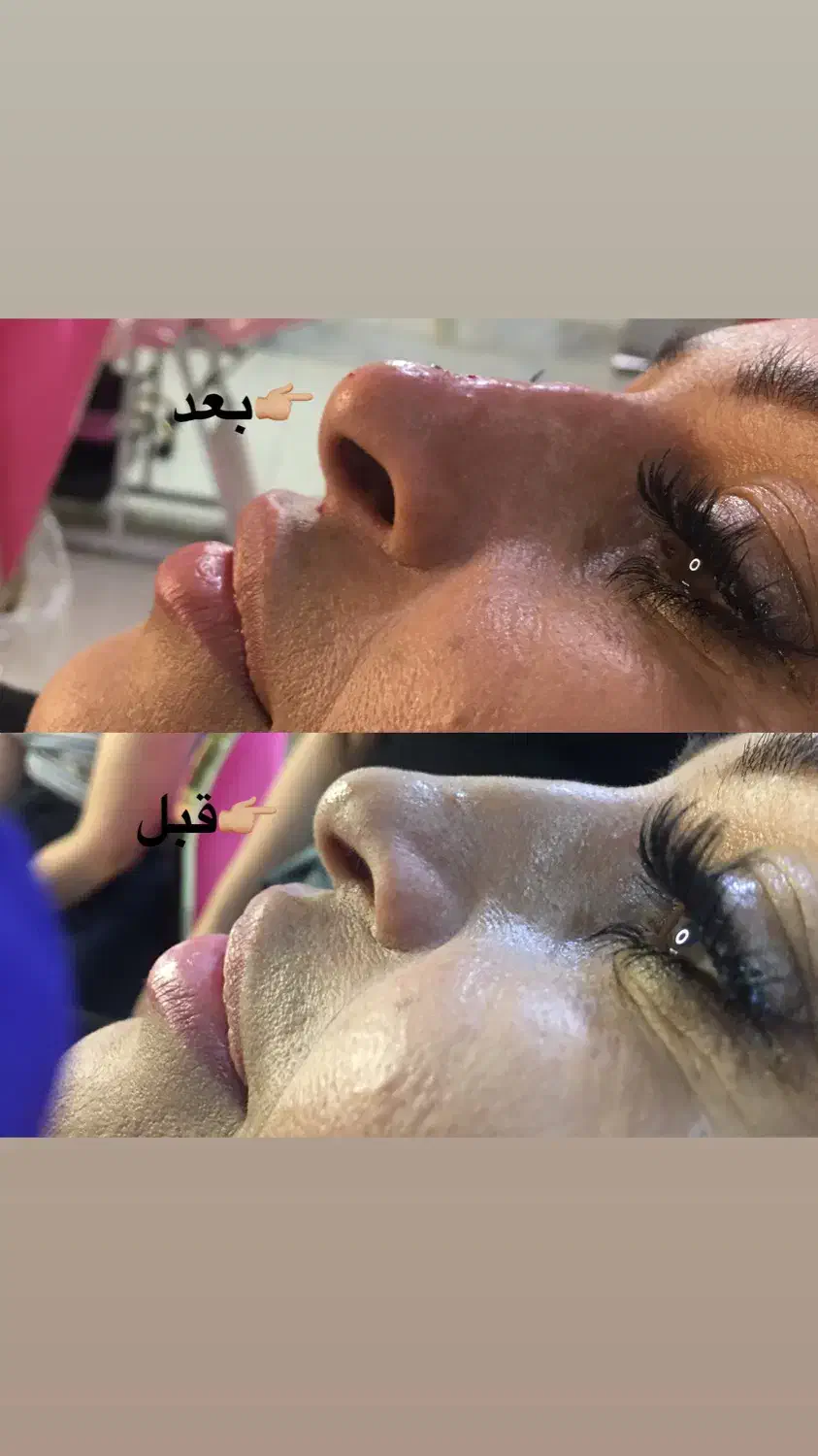 تخفیفات ژل وبوتاکس برای خانمهاواقایون|خدمات آرایشگری و زیبایی|قرچک, مهدیه|دیوار