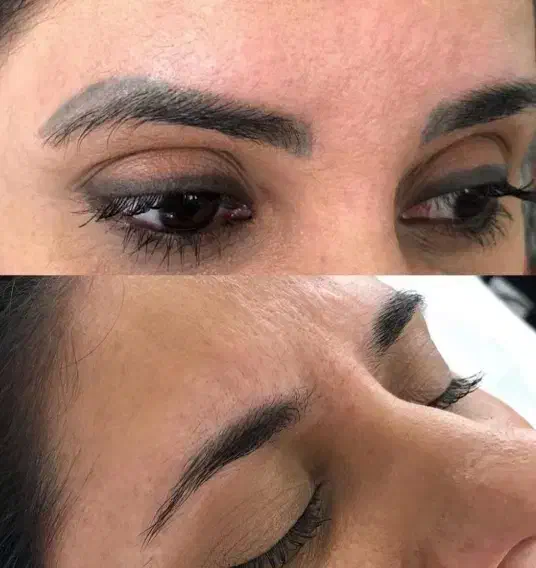 ریموو تتو های قدیمی بدن با دستگاه لیزر کیوسوییچ|خدمات آرایشگری و زیبایی|اردبیل, |دیوار