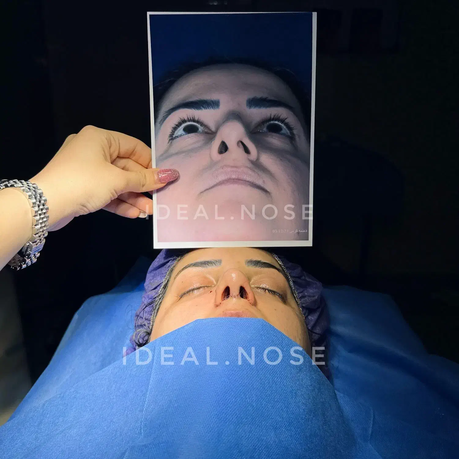 جراحی-زیبایی-بینی|خدمات آرایشگری و زیبایی|کرمانشاه, |دیوار