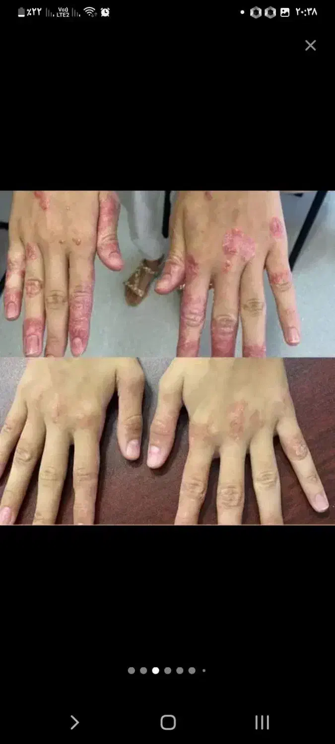 درمان قطعی وبدون بازگشت پوستی|آرایشی، بهداشتی، درمانی|سیرجان, |دیوار