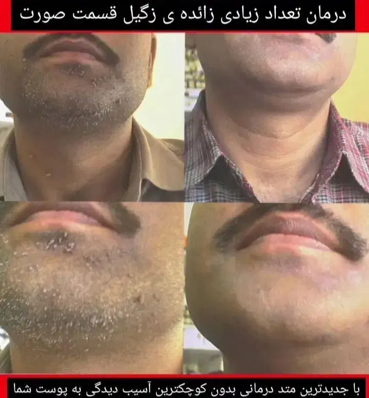 درمان ریشه ای تبخال و زگیل تناسلی با گیاهان دارویی|خدمات آرایشگری و زیبایی|اهواز, گلستان|دیوار