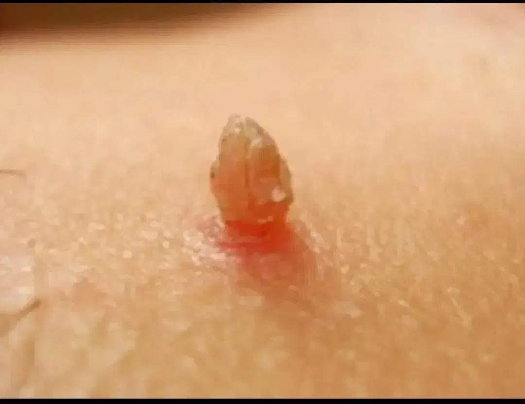 رفع hpv|آرایشی، بهداشتی، درمانی|لاهیجان, شیشه گران|دیوار