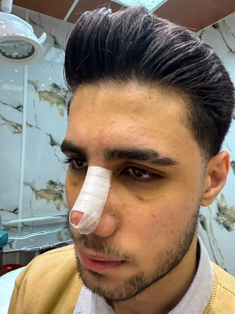 لیفت شقیقه توسط متخصص چشم تخفیف ویژه سه نفر اول|خدمات آرایشگری و زیبایی|تهران, تجریش|دیوار