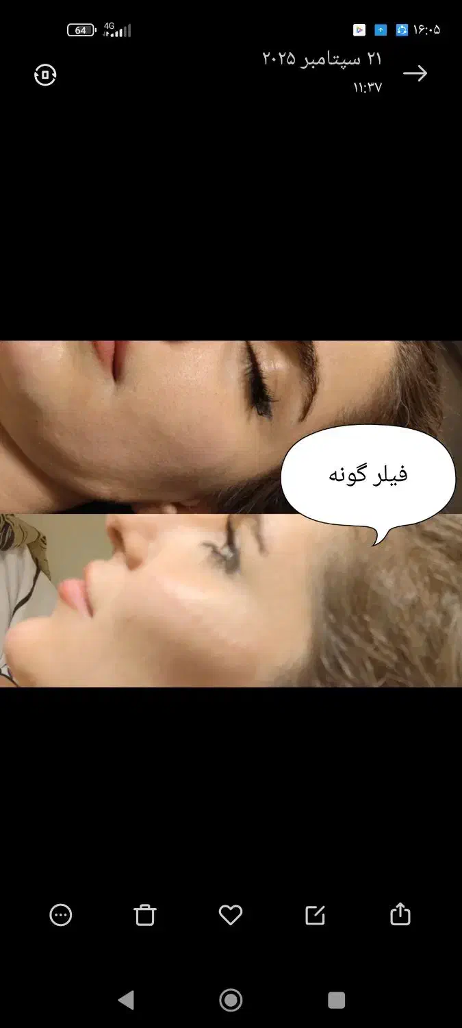 ترریق ژل و بوتاکس|خدمات آرایشگری و زیبایی|اصفهان, کوی شهید کشوری|دیوار