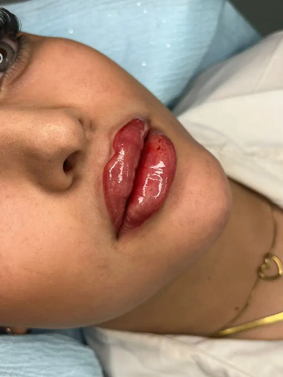 آموزش تزریقات زیبایی|خدمات آموزشی|تبریز, |دیوار