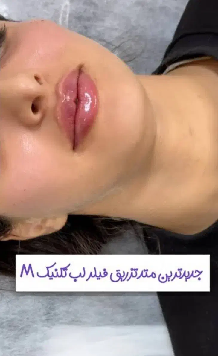 ژل ، بوتاکس ، چربی ، فیلر|خدمات آرایشگری و زیبایی|کرمانشاه, |دیوار