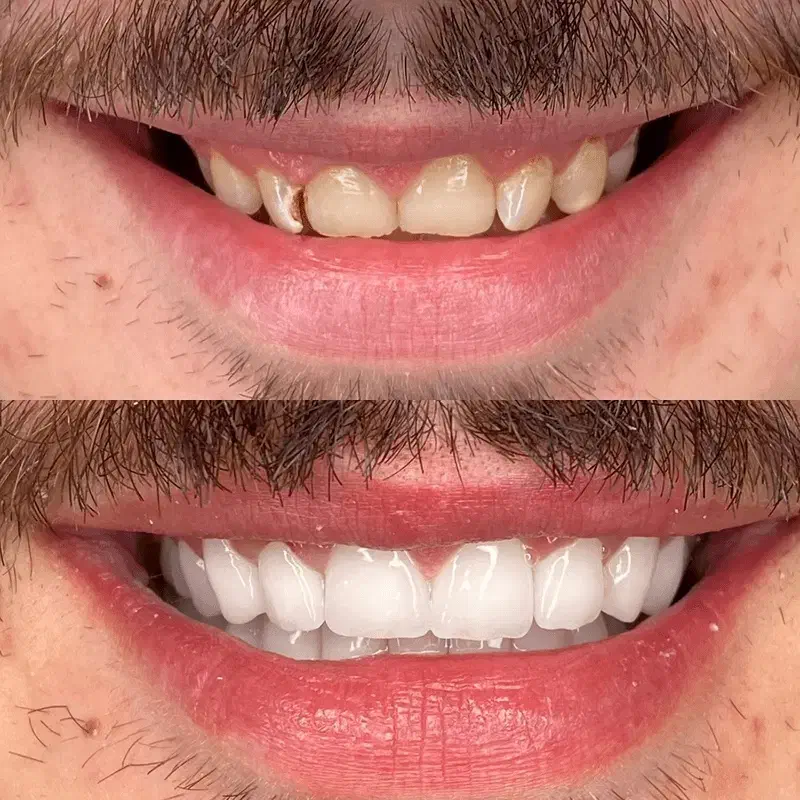 دندانپزشکی/ کامپوزیت زیبایی/ لمینت/دندان مصنوعی|خدمات آرایشگری و زیبایی|تهران, نعمت‌آباد|دیوار