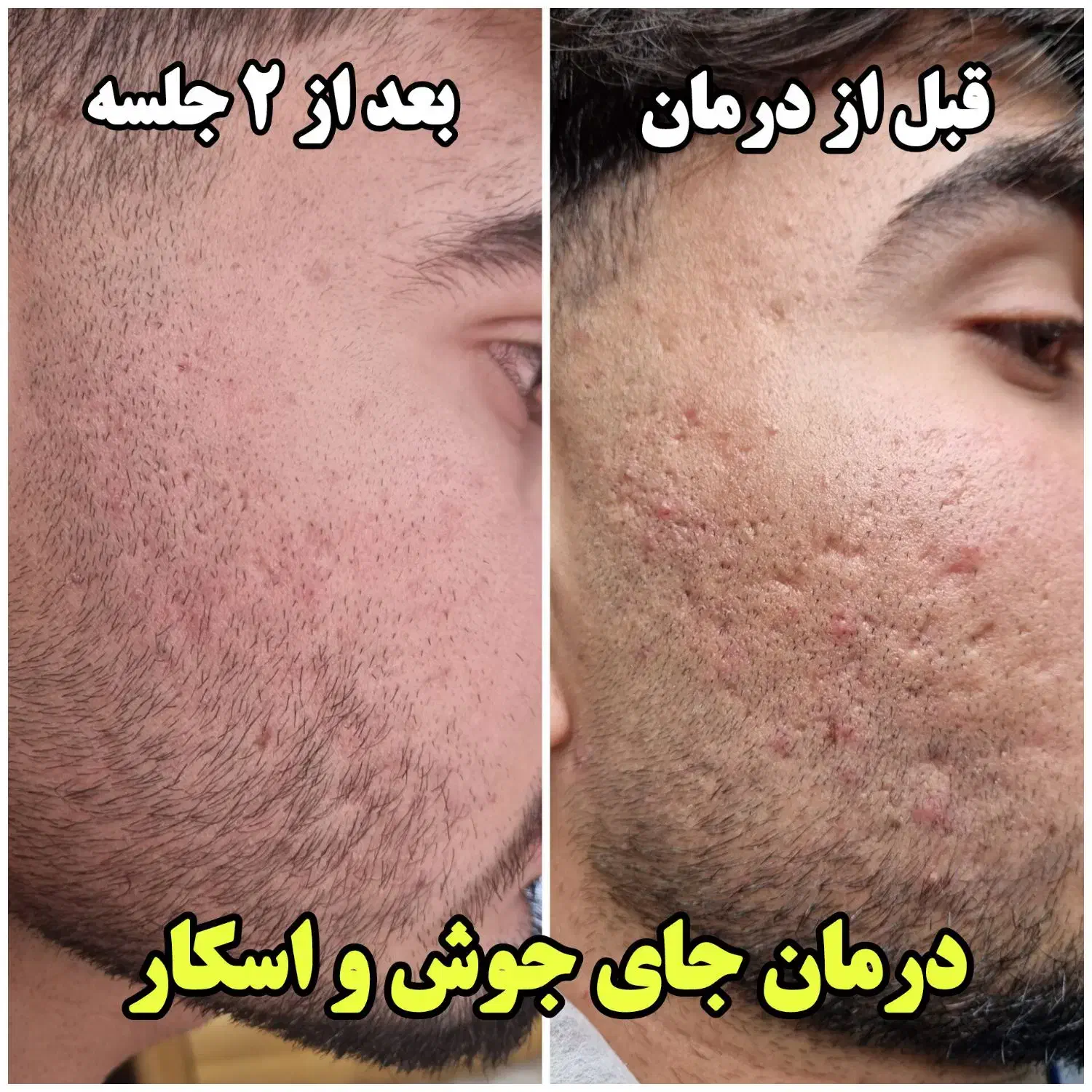 زیبایی صورتت با ما / مزونیدلینگ صورت|خدمات آرایشگری و زیبایی|یاسوج, |دیوار
