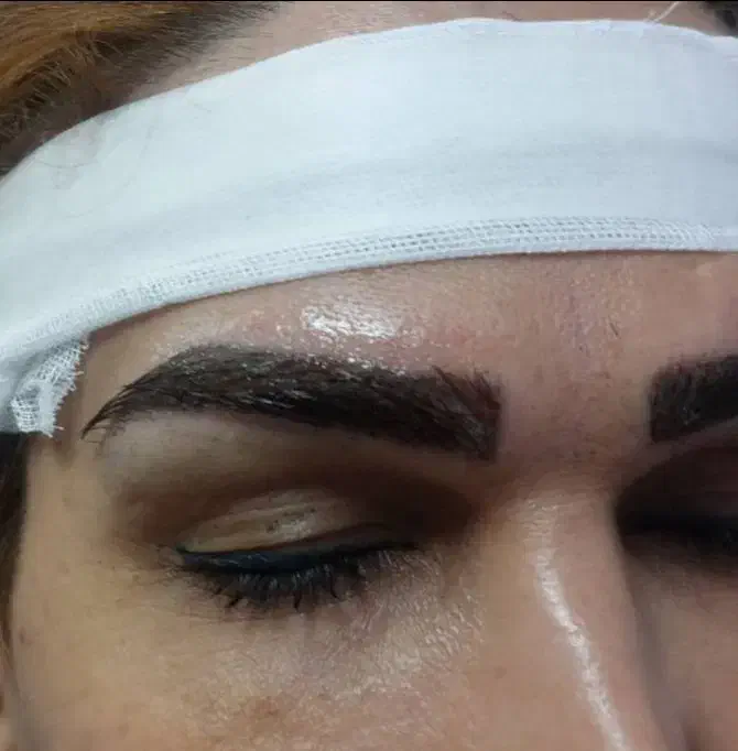 کاشت مو و ریش و ابرو|خدمات آرایشگری و زیبایی|یاسوج, |دیوار