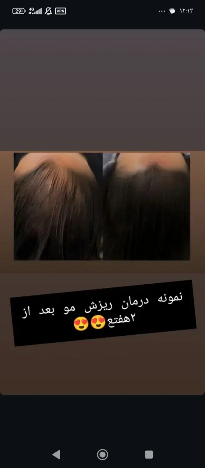 درماان ریشه ای ریزش مو|آرایشی، بهداشتی، درمانی|خلخال, |دیوار