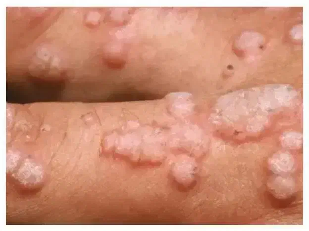 درمان خانگی زگیل و تبخال تناسلی|آرایشی، بهداشتی، درمانی|اصفهان, شهرک زاینده رود|دیوار