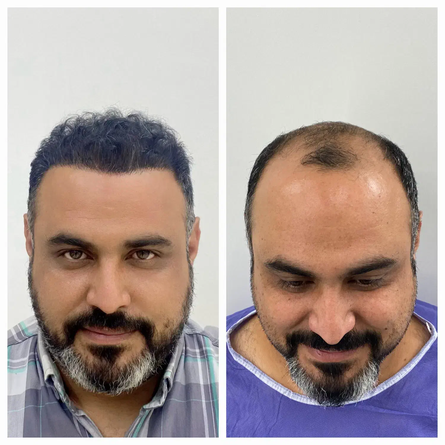 کاشت مو، ریش، ابرو|خدمات آرایشگری و زیبایی|تهران, الهیه|دیوار