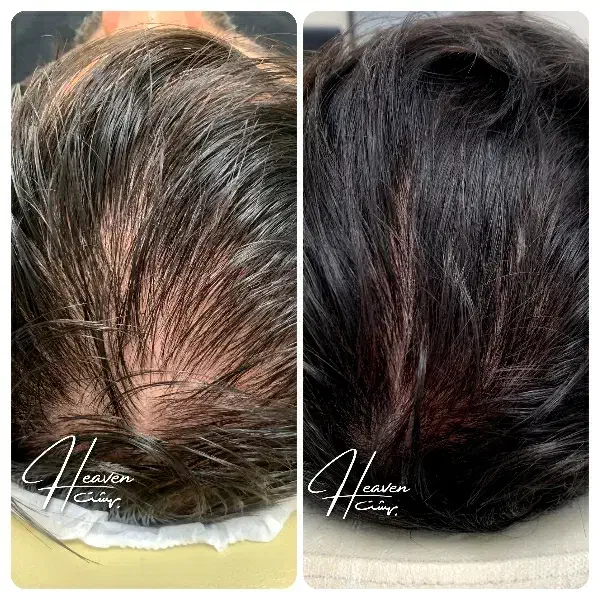 لیزر پی ار پی ژل فیلر بوتاکس لیفت نخ پی ارپی prp|خدمات آرایشگری و زیبایی|مشهد, هفت تیر (حافظ)|دیوار