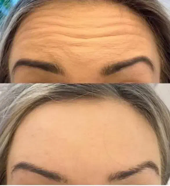 آف ژل بوتاکس مناسبت روز زن|خدمات آرایشگری و زیبایی|ایذه, |دیوار