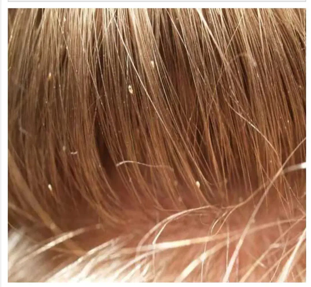 داروشپش.درمان شپش و رشک|آرایشی، بهداشتی، درمانی|گلبهار, شهر جدید گلبهار|دیوار