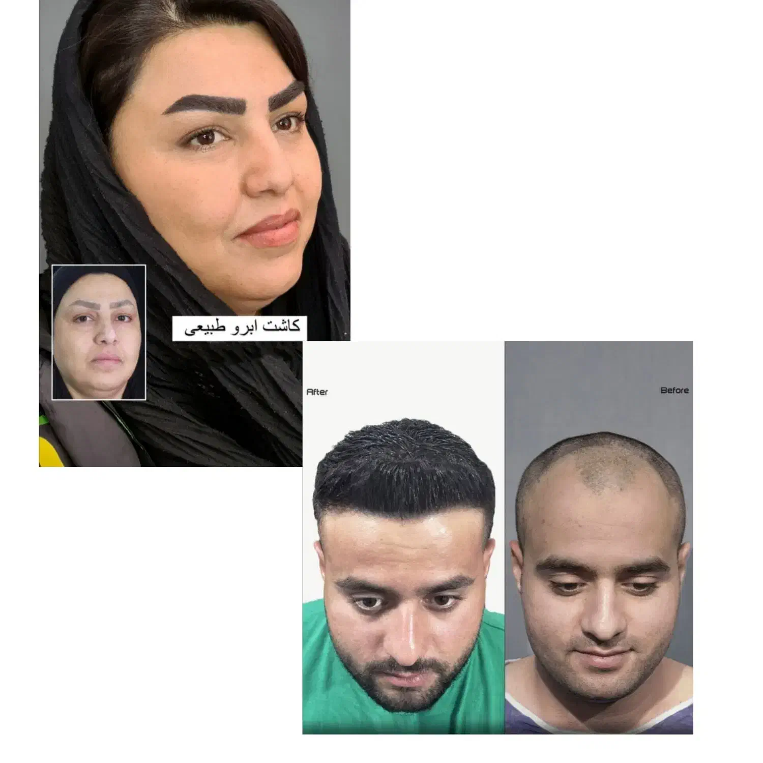 اقتصادی ترین کلینیک کاشت مو و ابرو در تهران/ اقساط|خدمات آرایشگری و زیبایی|تهران, سعادت‌آباد|دیوار