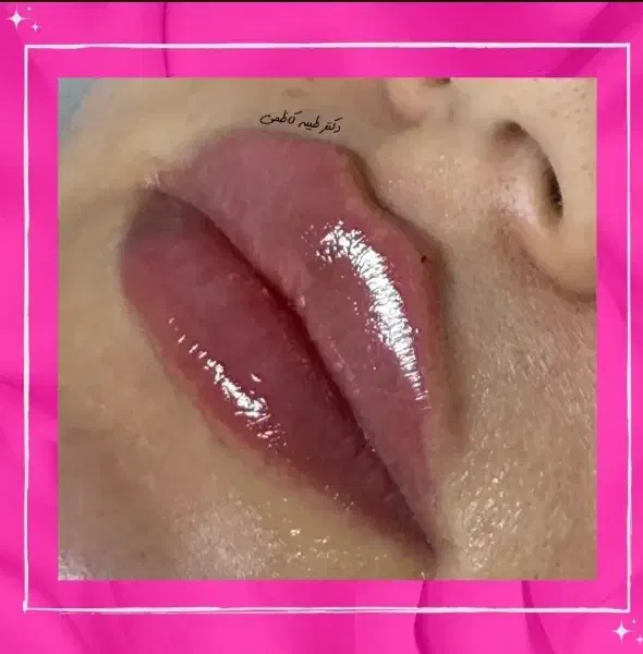 تخفیفات30درصدی ژل و بوتاکس وفیلر دکتر زیبایی|خدمات آرایشگری و زیبایی|مشهد, کوثر|دیوار