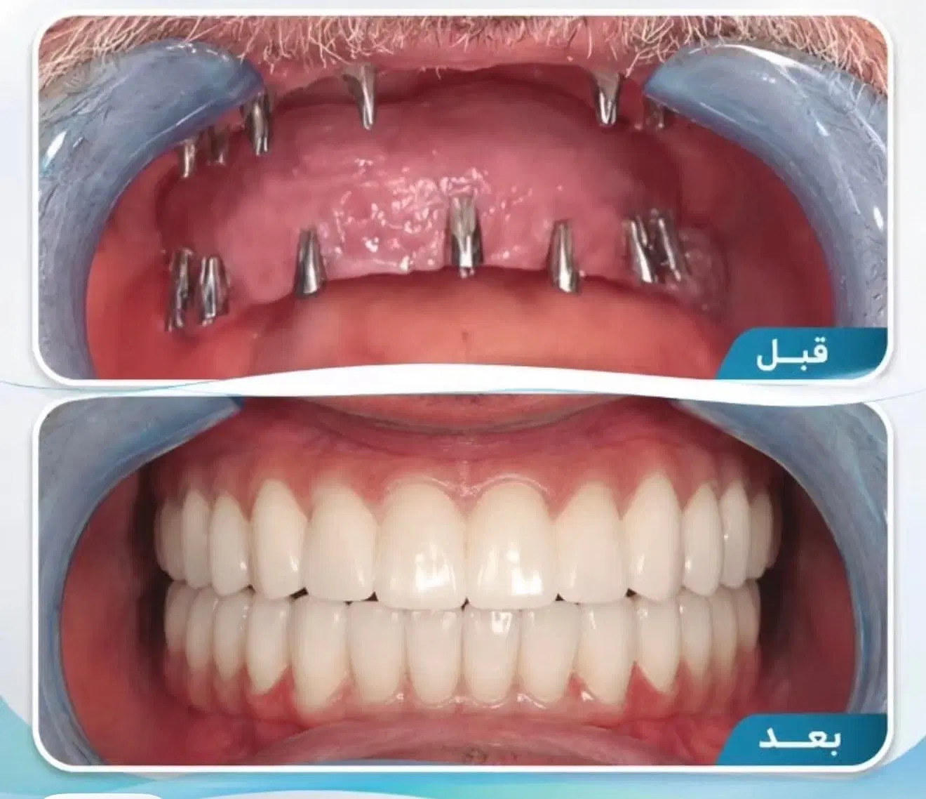 جشنواره ایمپلنت دیجیتال فرصت محدود|خدمات زیبایی و سلامت|تهران, گلستان (شهرک راه آهن)|دیوار
