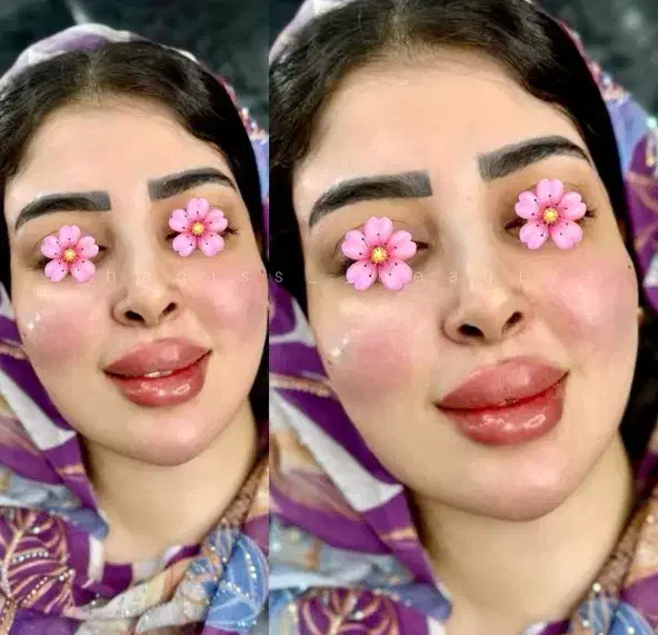 تزریق ژل فقط سیسی ۸۰۰بمدت سه روز|خدمات آرایشگری و زیبایی|زاهدان, |دیوار