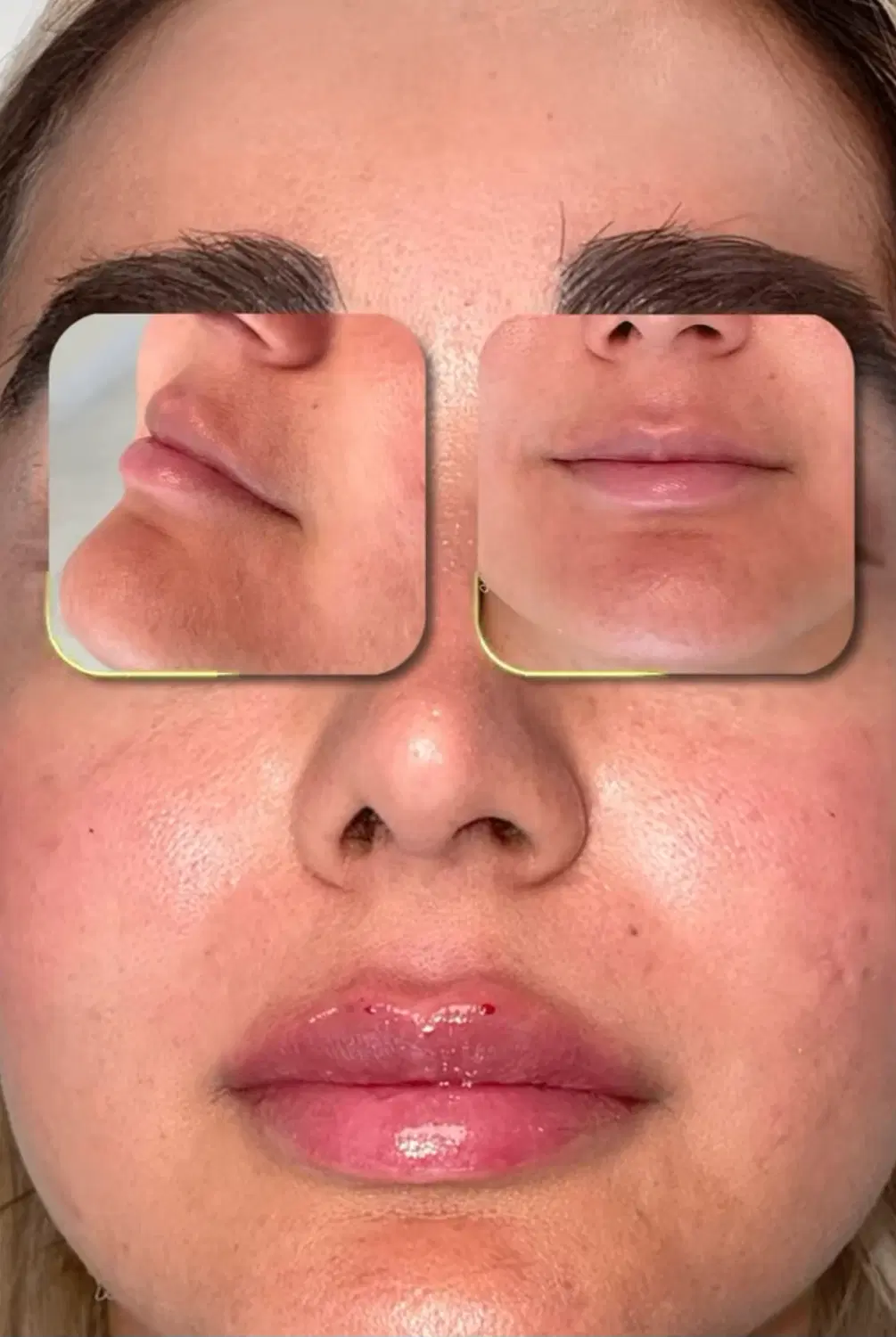 تزریق ژل لب بوتاکس فیلر بادی کانتورینگ صورت مزو|خدمات زیبایی و سلامت|تهران, صادقیه|دیوار