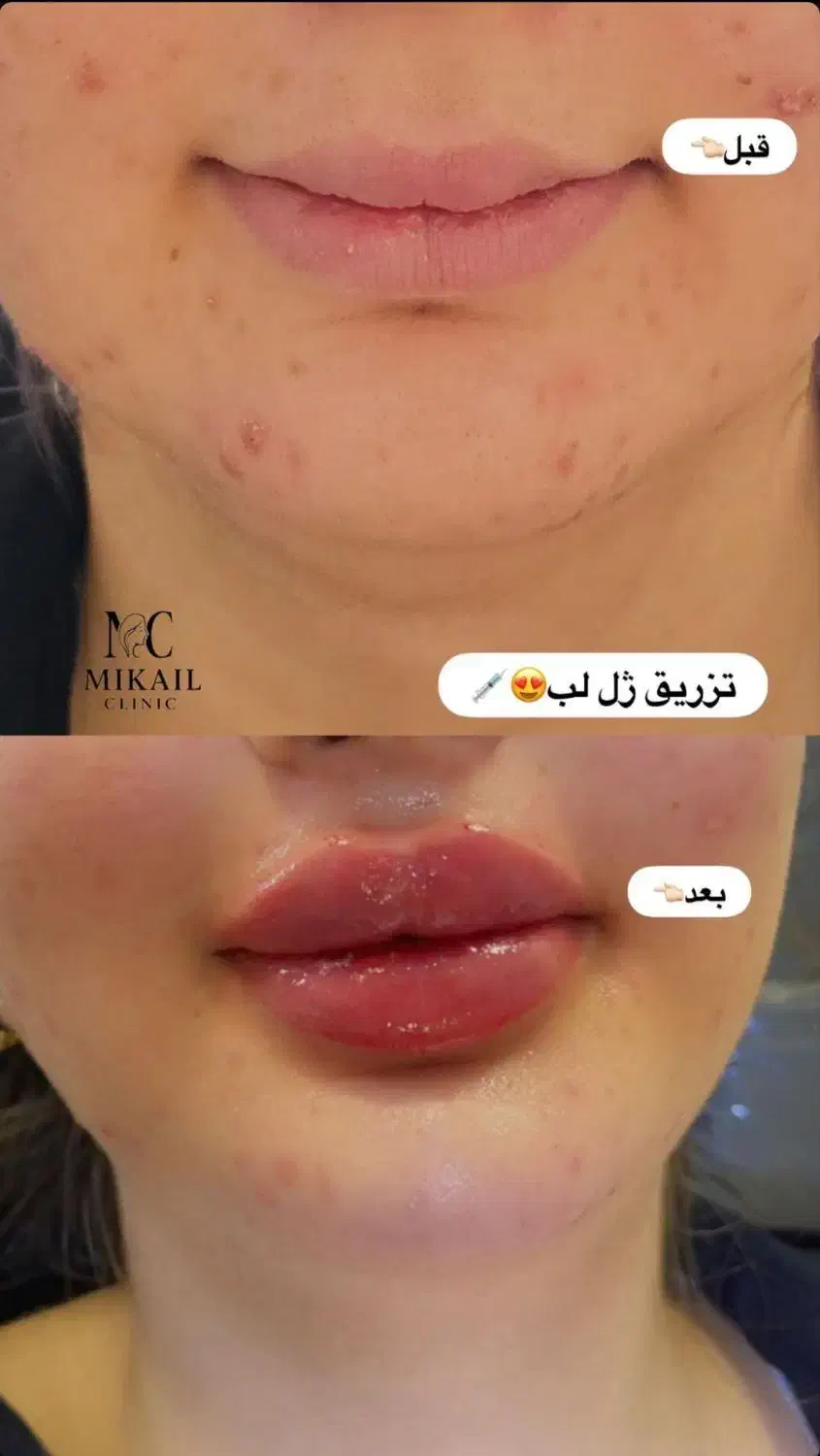 خدمات زیبایی رایگان،فیلر بوتاکس مزو ژل توسط متخصص|خدمات آرایشگری و زیبایی|ارومیه, |دیوار